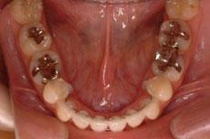 上顎前突（出っ歯）：出っ歯の矯正 10 - 片方舌側矯正装置 （上下左右4本抜歯）