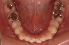 上顎前突（出っ歯）：出っ歯の矯正 10 - 片方舌側矯正装置 （上下左右4本抜歯）