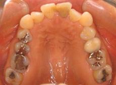 上顎前突（出っ歯）：出っ歯の矯正 5 - 上下舌側矯正装置（上顎2本抜歯）