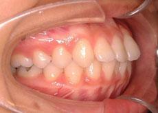 上顎前突（出っ歯）：出っ歯の矯正 7 - 出っ歯の矯正 7 - セルフライゲーションブラケット装置（デイモンシステム）（上下左右4本抜歯）