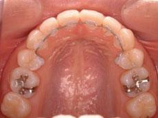 上顎前突（出っ歯）：出っ歯の矯正 7 - 出っ歯の矯正 7 - セルフライゲーションブラケット装置（デイモンシステム）（上下左右4本抜歯）