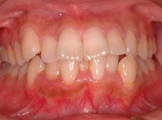上顎前突（出っ歯）：出っ歯の矯正 6 - 片方舌側矯正装置 （上下ディスキング）