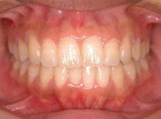 上顎前突（出っ歯）：出っ歯の矯正 6 - 片方舌側矯正装置 （上下ディスキング）