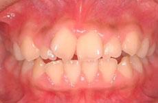 叢生（八重歯、乱ぐい歯）：叢生の矯正 2 - セルフライゲーションブラケット装置（デイモンシステム）（非抜歯）