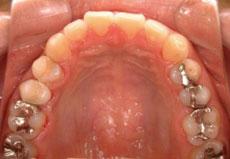 空隙歯列（すきっ歯）：空隙歯列の矯正 3 - 上下舌側矯正装置 （非抜歯、上顎に歯科矯正用アンカースクリュー1本埋入）