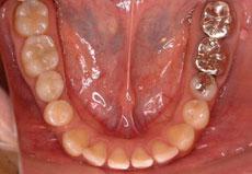 空隙歯列（すきっ歯）：空隙歯列の矯正 3 - 上下舌側矯正装置 （非抜歯、上顎に歯科矯正用アンカースクリュー1本埋入）