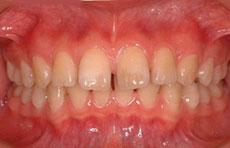 空隙歯列（すきっ歯）：空隙歯列の矯正 1 - セルフライゲーションブラケット装置（デイモンシステム）（非抜歯）