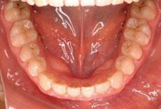 空隙歯列（すきっ歯）：空隙歯列の矯正 1 - セルフライゲーションブラケット装置（デイモンシステム）（非抜歯）