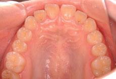 空隙歯列（すきっ歯）：空隙歯列の矯正 2 - セルフライゲーションブラケット装置（デイモンシステム）（非抜歯）