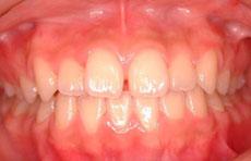 空隙歯列（すきっ歯）：空隙歯列の矯正 2 - セルフライゲーションブラケット装置（デイモンシステム）（非抜歯）