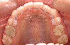 開咬：開咬の矯正 5 - セルフライゲーションブラケット装置（デイモンシステム）（上顎2本抜歯）