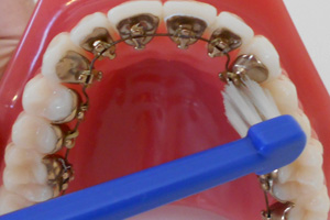 裏側の装置の歯の磨き方