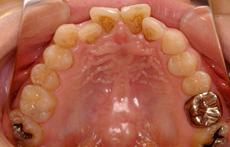上顎前突（出っ歯）：出っ歯の矯正 1 - セルフライゲーションブラケット装置（デイモンシステム）（上顎2本抜歯）