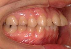 上顎前突（出っ歯）：出っ歯の矯正 1 - セルフライゲーションブラケット装置（デイモンシステム）（上顎2本抜歯）