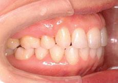 上顎前突（出っ歯）：出っ歯の矯正 2 - セルフライゲーションブラケット装置（デイモンシステム）（上顎2本抜歯）