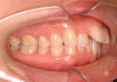 上顎前突（出っ歯）：出っ歯の矯正 2 - セルフライゲーションブラケット装置（デイモンシステム）（上顎2本抜歯）