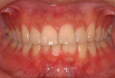 上顎前突（出っ歯）：出っ歯の矯正 12 - 片方舌側矯正装置（上下ディスキング）