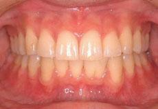 上顎前突（出っ歯）：出っ歯の矯正 12 - 片方舌側矯正装置（上下ディスキング）