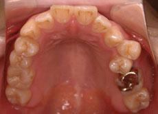 上顎前突（出っ歯）：出っ歯の矯正 11 - 片方舌側矯正装置 （上下左右4本抜歯）