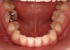 上顎前突（出っ歯）：出っ歯の矯正 11 - 片方舌側矯正装置 （上下左右4本抜歯）
