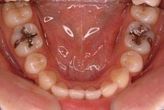上顎前突（出っ歯）：出っ歯の矯正 9 - 上下舌側矯正装置 （上下左右4本抜歯）