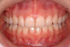 上顎前突（出っ歯）：出っ歯の矯正 9 - 上下舌側矯正装置 （上下左右4本抜歯）