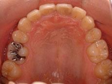 上顎前突（出っ歯）：出っ歯の矯正 8 - 出っ歯の矯正 7 - セルフライゲーションブラケット装置（デイモンシステム）（上下左右4本抜歯）
