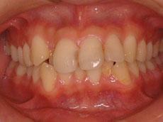 上顎前突（出っ歯）：出っ歯の矯正 8 - 出っ歯の矯正 7 - セルフライゲーションブラケット装置（デイモンシステム）（上下左右4本抜歯）