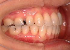 上顎前突（出っ歯）：出っ歯の矯正 5 - 上下舌側矯正装置（上顎2本抜歯）