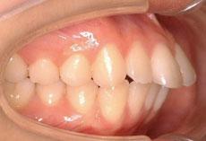 上顎前突（出っ歯）：出っ歯の矯正 4 - セルフライゲーションブラケット装置（デイモンシステム）（上下左右4本抜歯）