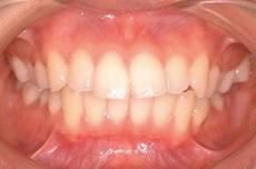 上顎前突（出っ歯）：出っ歯の矯正 4 - セルフライゲーションブラケット装置（デイモンシステム）（上下左右4本抜歯）