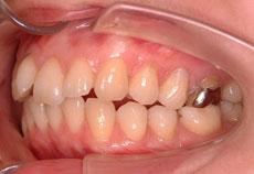 上顎前突（出っ歯）：出っ歯の矯正 3 - セルフライゲーションブラケット装置（デイモンシステム）（上顎2本抜歯）
