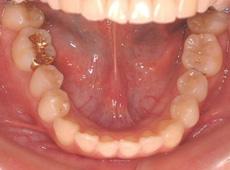上顎前突（出っ歯）：出っ歯の矯正 3 - セルフライゲーションブラケット装置（デイモンシステム）（上顎2本抜歯）