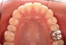 反対咬合（受け口）：反対咬合（受け口）の矯正2 - 上下舌側矯正装置 （非抜歯）
