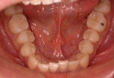反対咬合（受け口）：反対咬合（受け口）の矯正2 - 上下舌側矯正装置 （非抜歯）