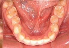 反対咬合（受け口）：反対咬合（受け口）の矯正 1 - 上下舌側矯正装置 （下顎1本抜歯）