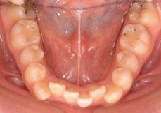 叢生（八重歯、乱ぐい歯）：叢生の矯正 5 - 片方舌側矯正装置（上下ディスキング）
