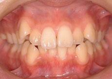 叢生（八重歯、乱ぐい歯）：叢生の矯正 5 - 片方舌側矯正装置（上下ディスキング）