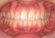 叢生（八重歯、乱ぐい歯）：叢生の矯正 5 - 片方舌側矯正装置（上下ディスキング）