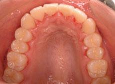 叢生（八重歯、乱ぐい歯）：叢生の矯正 4 - 片方舌側矯正装置（上下ディスキング）