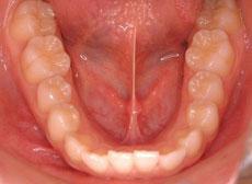 叢生（八重歯、乱ぐい歯）：叢生の矯正 4 - 片方舌側矯正装置（上下ディスキング）