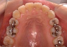 叢生（八重歯、乱ぐい歯）：叢生の矯正 3 - セルフライゲーションブラケット装置（デイモンシステム）（非抜歯）