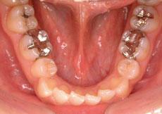叢生（八重歯、乱ぐい歯）：叢生の矯正 3 - セルフライゲーションブラケット装置（デイモンシステム）（非抜歯）