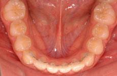 叢生（八重歯、乱ぐい歯）：叢生の矯正 2 - セルフライゲーションブラケット装置（デイモンシステム）（非抜歯）