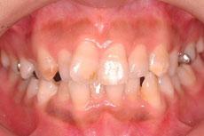 叢生（八重歯、乱ぐい歯）：叢生の矯正 1 - セルフライゲーションブラケット装置（デイモンシステム）（非抜歯）