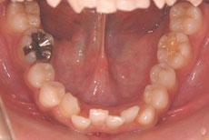 叢生（八重歯、乱ぐい歯）：叢生の矯正 1 - セルフライゲーションブラケット装置（デイモンシステム）（非抜歯）