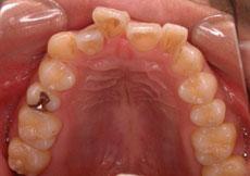 開咬：開咬の矯正 6 - セルフライゲーションブラケット装置（デイモンシステム）（非抜歯）