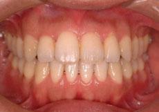 開咬：開咬の矯正 6 - セルフライゲーションブラケット装置（デイモンシステム）（非抜歯）