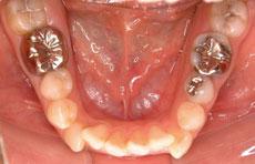 開咬：開咬の矯正 5 - セルフライゲーションブラケット装置（デイモンシステム）（上顎2本抜歯）