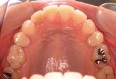 開咬：開咬の矯正 4 - セルフライゲーションブラケット装置（デイモンシステム）（上顎2本抜歯）